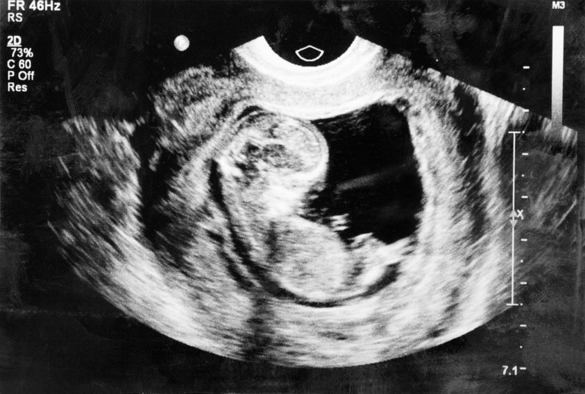 Bambino di pietra gravidanza extrauterina rara