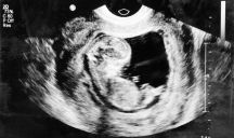 Bambino di pietra: Lithopedion, gravidanza extrauterina rara