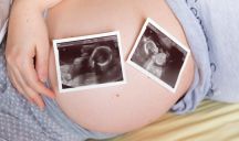 Sindrome da trasfusione feto-fetale nelle gravidanze gemellari monocoriali