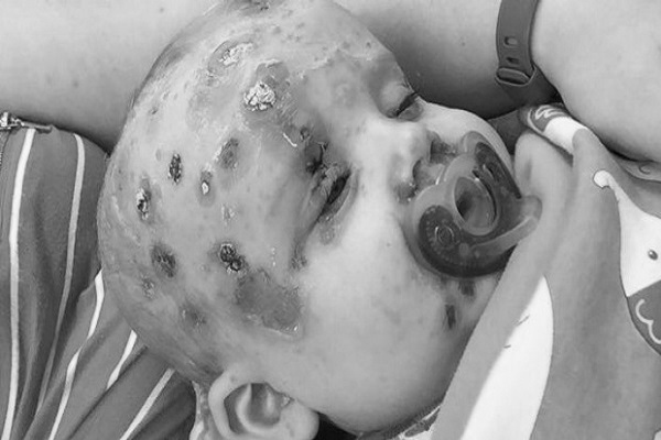 neonato non vaccinato varicella