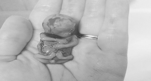 aborto spontaneo foto 11 settimane