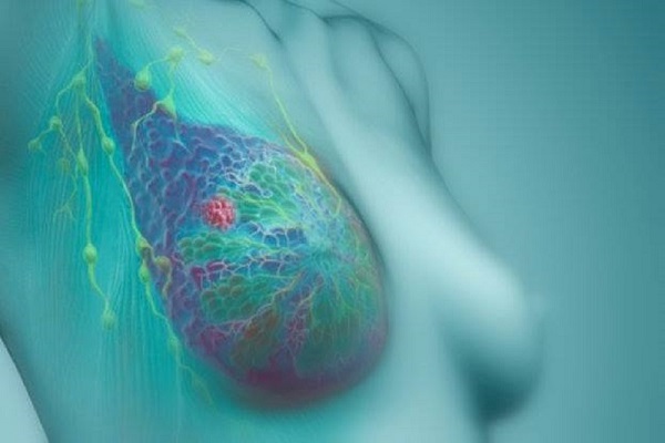 il tumore al seno sintomi
