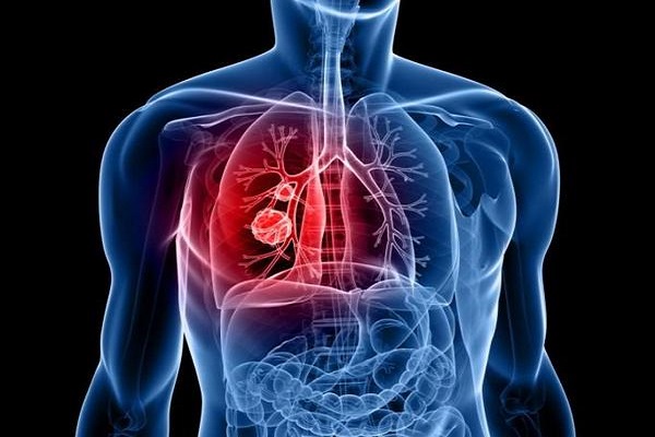sintomi del cancro ai polmoni