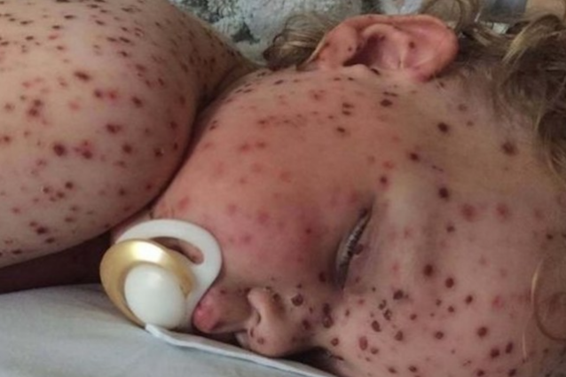 bambino malato di varicella