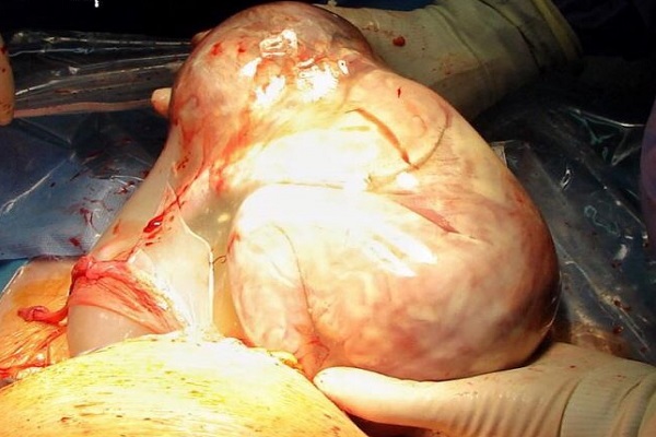 nascere con il sacco amniotico intatto