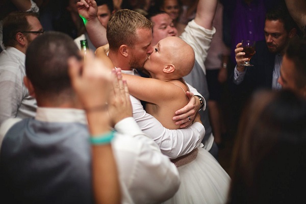Kylie Bamberger, malata di alopecia, si sposa senza parrucca