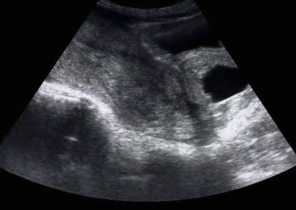 25enne parla del suo aborto spontaneo: "La mia speranza per te"