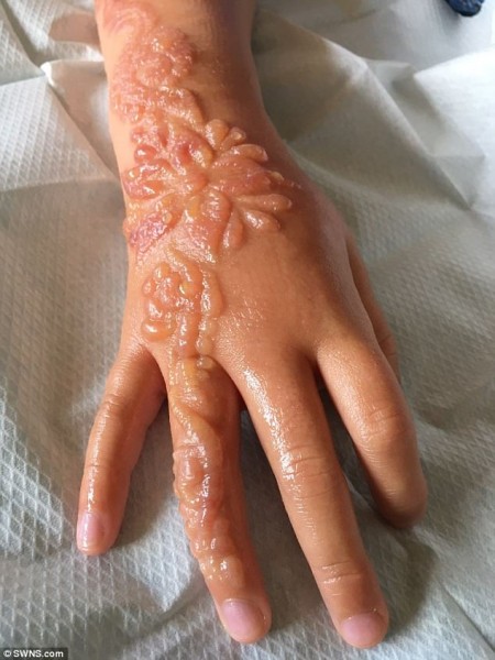 Tatuaggio hennè nero: bimba gravemente ustionata