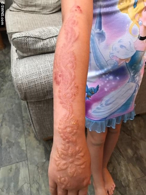 Tatuaggio hennè nero: bimba gravemente ustionata