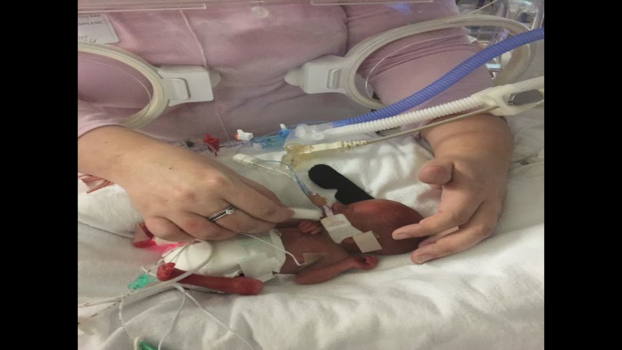 Poppy Wicks: più piccola neonata prematura sopravvissuta