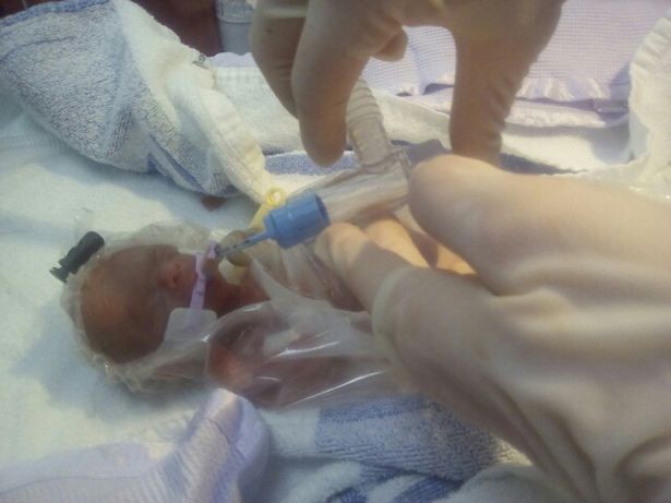 Poppy Wicks: più piccola neonata prematura sopravvissuta