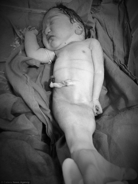 Sindrome della sirena: neonato sopravvive per 4 ore