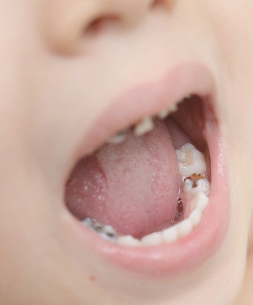 Carie nei denti da latte prevenzione