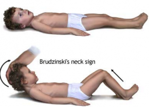 segno di brudzinski sintomi della meningite