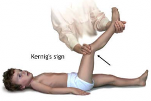 segno di kernig sintomi della maningite