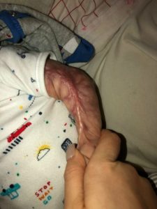 bambino nato senza pelle
