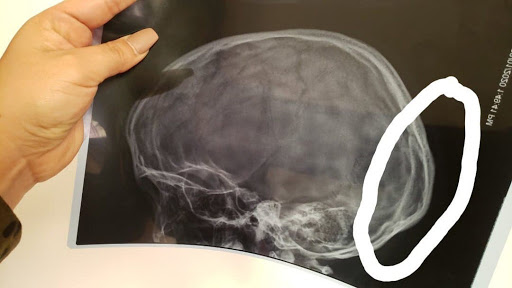 La Skullbreaker Challenge espone al pericolo di morte, lo spiegano i medici: