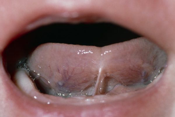 Frenulo linguale corto neonato