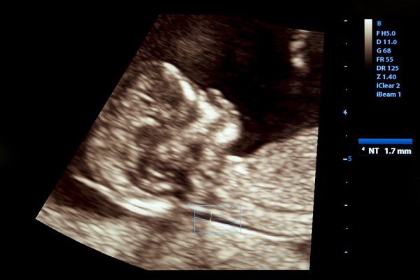 37 settimane di gravidanza: straordinari movimenti del bebè nella pancia della mamma