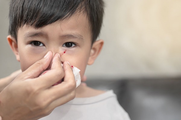 Epistassi nei bambini: sangue dal naso, cosa fare